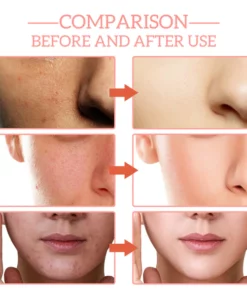 ruelens™ 5-in-1 Face Moisturizing Anti-Wrinkle Firming Acne Serum