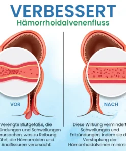 Quezy™ Hämorrhoiden Behandlung Gel