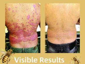 Bee Venom Psoriasis Treatment Cream