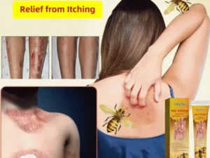 Bee Venom Psoriasis Treatment Cream