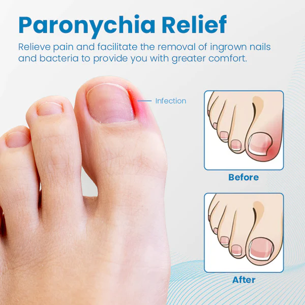 Ceoerty™ gel za liječenje noktiju protiv paronihije
