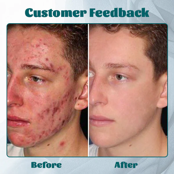 Ceoerty™ Männer Akne-Free Hydra Crème