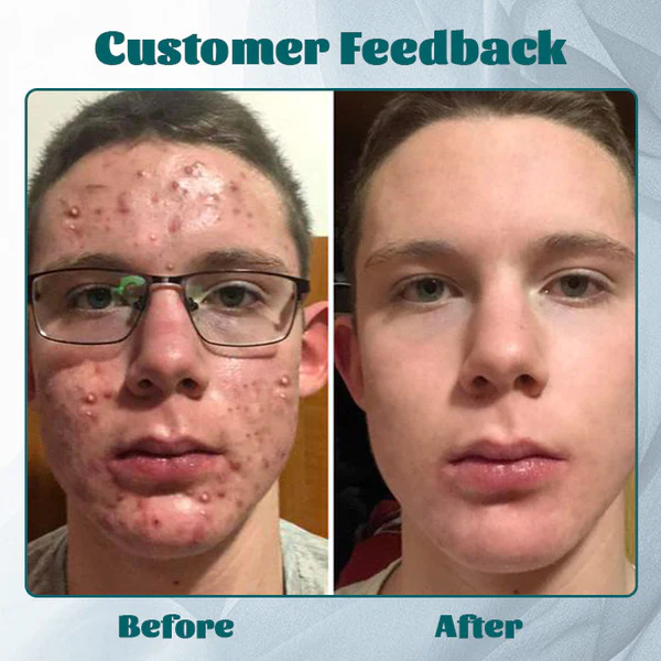 Ceoerty™ Männer Akne-Free Hydra Crème