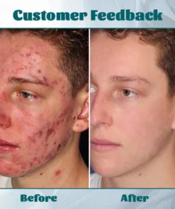 Ceoerty™ Men's AcneFree Hydra Cream