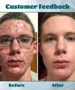 Ceoerty™ Men's AcneFree Hydra Cream