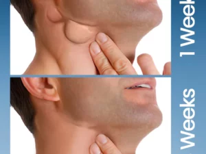 Ceoerty™ ThyroHeal Thyroid Lymph Node Patch