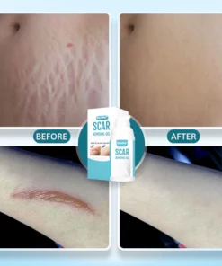 Cuzvc™ Scar Removal Gel