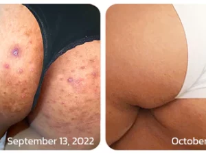 GFOUK™ BodyTreat Kollagen-Peeling-Essenz