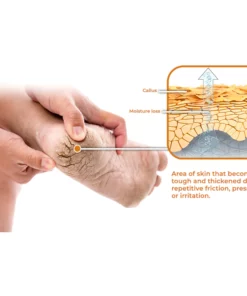 GFOUK™ Horse Oil Foot Callus Remedy Balm