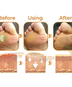 GFOUK™ Horse Oil Foot Callus Remedy Balm