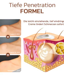 GFOUK™ Lumpless Lipom-Behandlungscreme