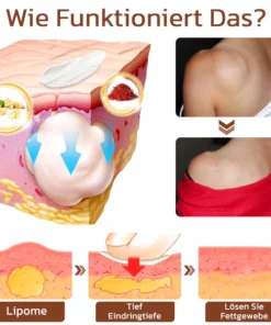 GFOUK™ Lumpless Lipom-Behandlungscreme