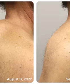 GFOUK™ Lumpless Lipom-Behandlungscreme