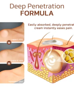 GFOUK™ Lumpless Lipoma Treatment Cream