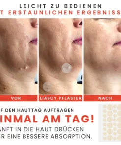 Liascy™ MicroDarts TAG'Gone Pflaster