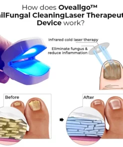 Oveallgo™ Dispositivo terapéutico con láser para limpieza de hongos y uñas