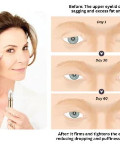 Oveallgo™ Eyelid Tightening Cream