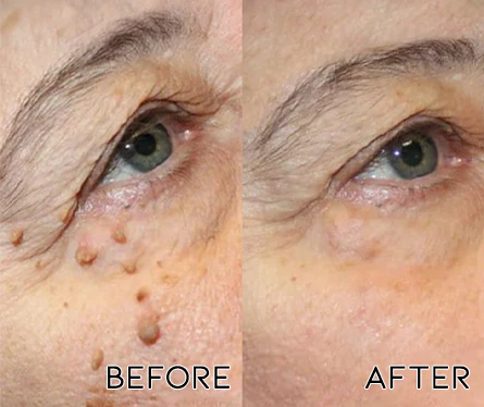 Oveallgo™ PlasmaBeam Facial Beauty Pen