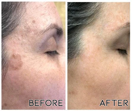 Oveallgo™ PlasmaBeam Facial Beauty Pen