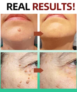 Oveallgo™ Tags & Moles Remover Pen