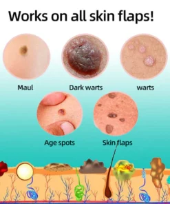 Oveallgo™ Tags & Moles Remover Pen