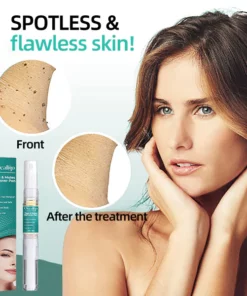 Oveallgo™ Tags & Moles Remover Pen