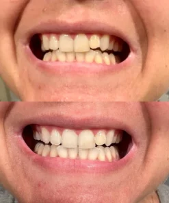 Oveallgo™ Whitening Purple Mousse Toothpaste