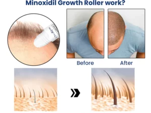 Oveallgrow™ ScalpRevive Minoxidil Growth Roller