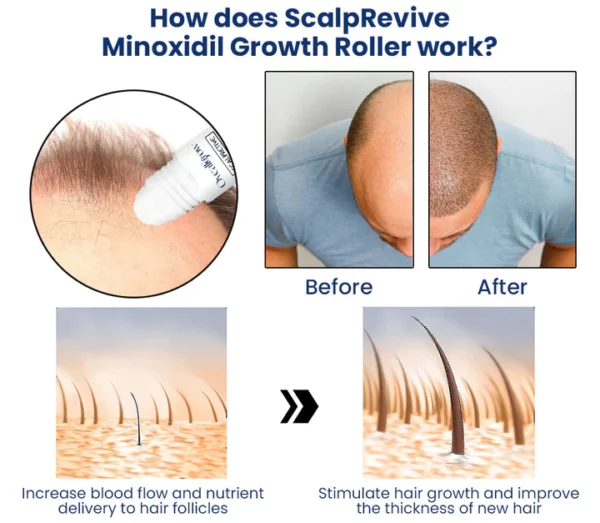 Oveallgrow™ ScalpRevive Minoxidil Growth Roller