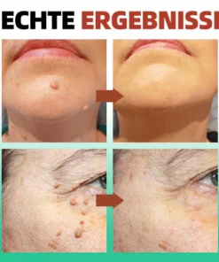 ReYouthBio® Etiketten- und Muttermale-Entferner