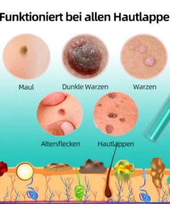 ReYouthBio® Etiketten- und Muttermale-Entferner