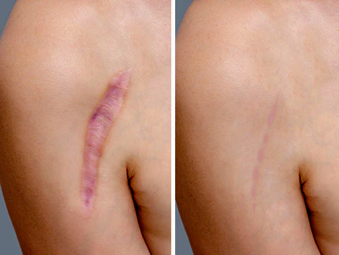 SkinFix™ Narbenreparatur-Essenz