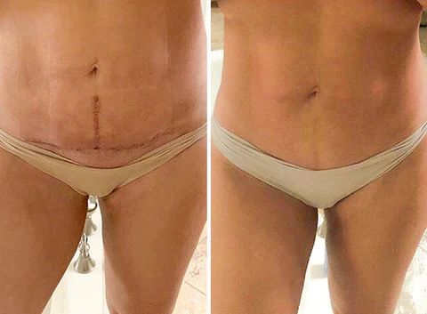 SkinFix™ Narbenreparatur-Essenz