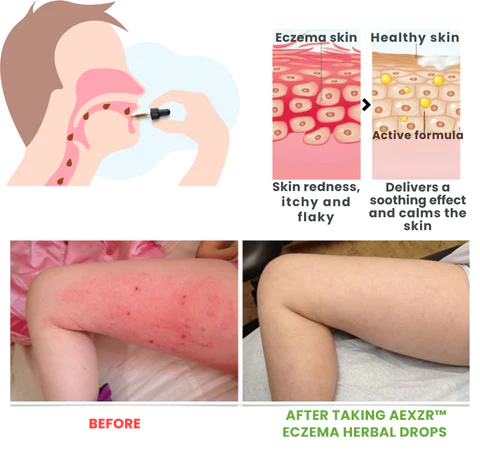 AEXZR™ Eczema Herbal Drops