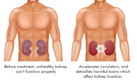 ASYRX Multi-Functional Kidney Care Patch