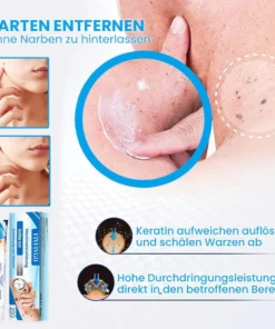 Fivfivgo™ MaximaleLeistung Salbe zur sofortigen Entfernung von Warzen