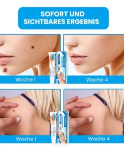 Fivfivgo™ MaximaleLeistung Salbe zur sofortigen Entfernung von Warzen