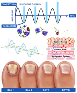 GFOUK™ FungusOFF Nail Laser Treatment Device