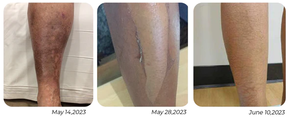 GFOUK™ PeelingPlus Acanthosis Nigricans Therapy Oil 