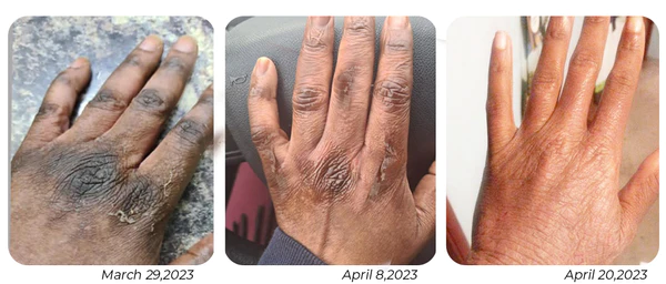 GFOUK™ PeelingPlus Acanthosis Nigricans Therapy Oil 