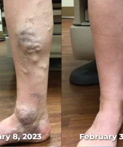 GFOUK™ SwellGuard Self-Heating Lymphatic Sleeves