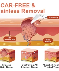 GFOUK™ WipeOff Tags And Moles Eliminator