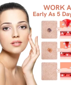 GFOUK™ WipeOff Tags And Moles Eliminator