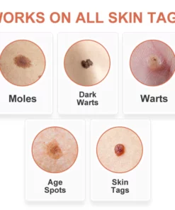 GFOUK™ WipeOff Tags And Moles Eliminator