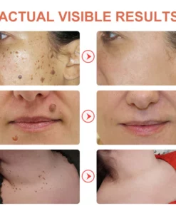 GFOUK™ WipeOff Tags And Moles Eliminator