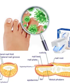 Golfkoo™ Revolutionäres hocheffizientes Lichttherapiegerät für Zehennagelkrankheiten