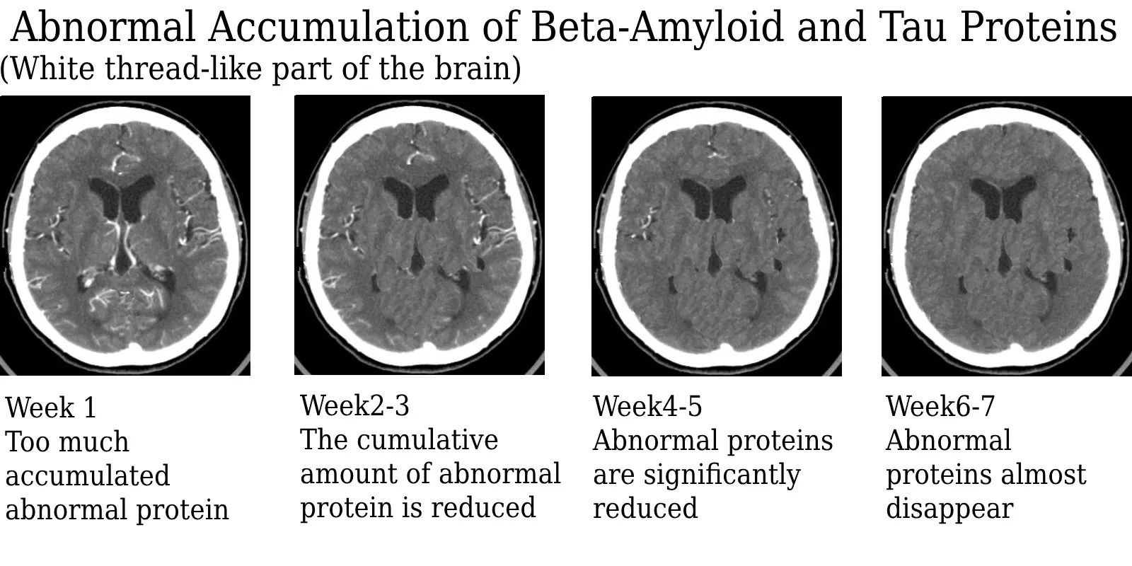 Healsy™ Brain Abnormal Protein Clearance Nasal Spray 