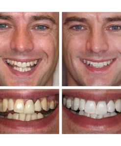 LIMETOW™ Teeth Whitening Gel