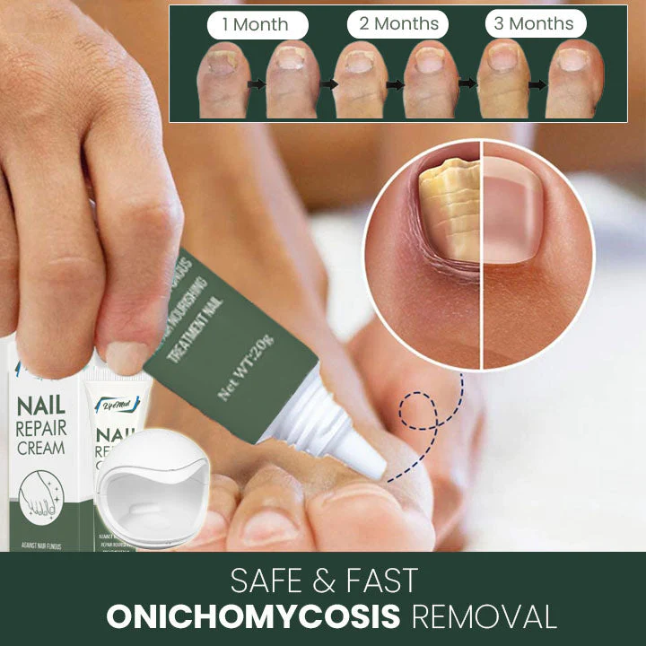 Oveallgo™ LifeMed Home Use Onychomycosis Fungal Laser Treatment