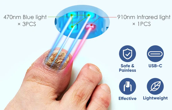 Oveallgo™ Revolutionary PharmaPro High-Efficiency Light Therapy Device For Toenail Diseases